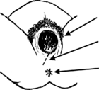 ilustración de un corte del mediolateral.